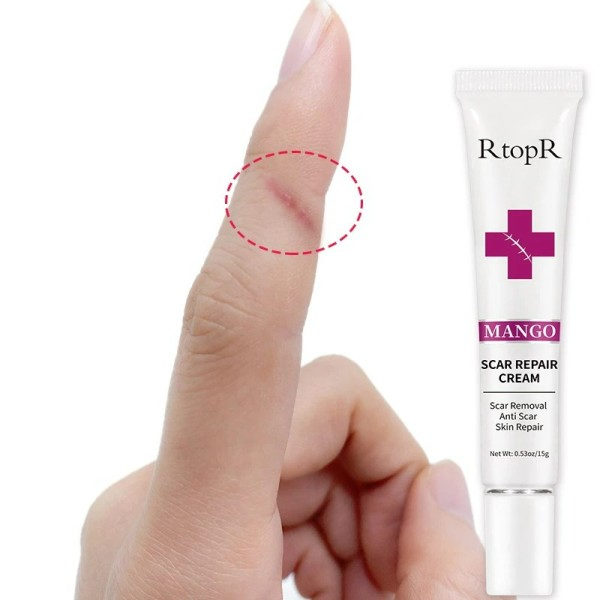 Fade Är Stretch Marks Remover Cream Skin Repair Ansikte Cream Acne Fläckar Acne Behandling