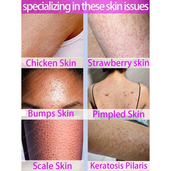 Pilaris Behandling Jordbær Ben Fjernelse Bumpy Rough Kylling Skin Remover Creme