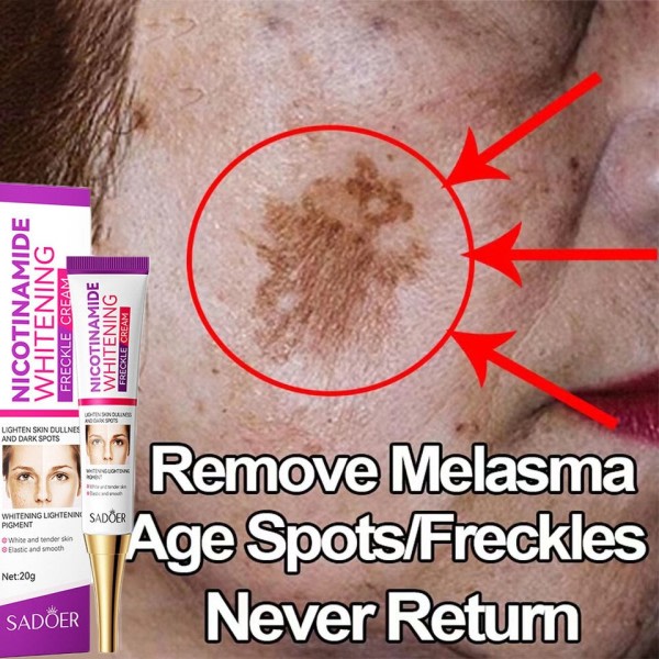 Ansigtsbehandling pletter hud mørk plet fjern melasma alder pletter solpletter hvidning og fregne fjernelse creme