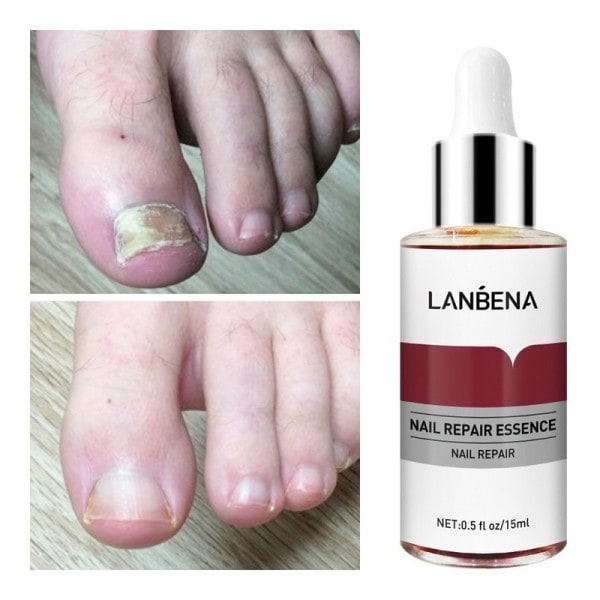 Svamp Nagel Reparation Essence Serum Care Finger Tå Anti Nagel Reparation Fotvård Svamp Nagel Behandling Vätske