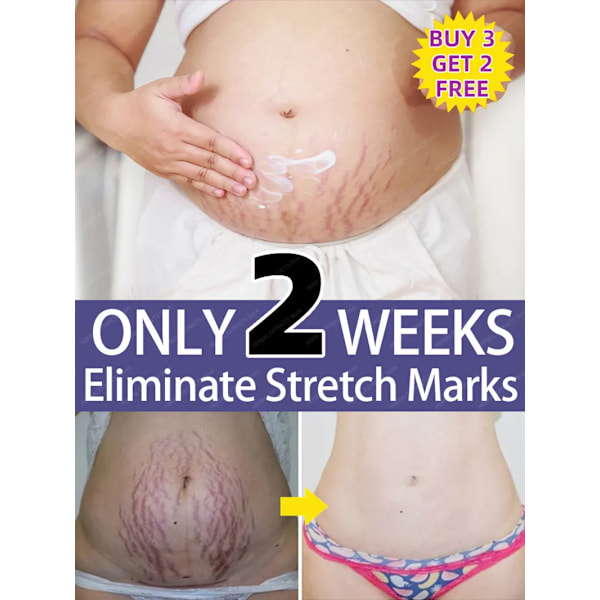 Stretch Marks Permanent Removal Cream Eliminate Body Belly Stretch Marks För tunnlar