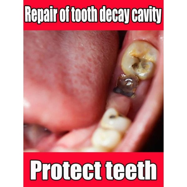 Tænder reparation Reparation alle tandforfald huler og beskytter tænder Fjernelse af plak pletter