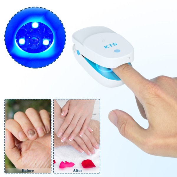 Sopp Negler Behandling Laser Enhet For Negler Sopp Negler Fjerning