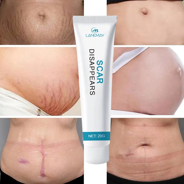 Recovery Ar Cream Hurtig Fjernelse Stræk Mærker Forbrændinger Keloider Behandling Kirurgi Ar Pigment Urte Reparation Hud Ar Glat Gel