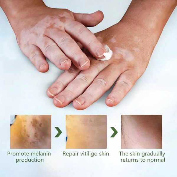 Effektivt vitiligo reparation salve urte fjernelse ringorm hvid plet creme fjern få kvit af hud