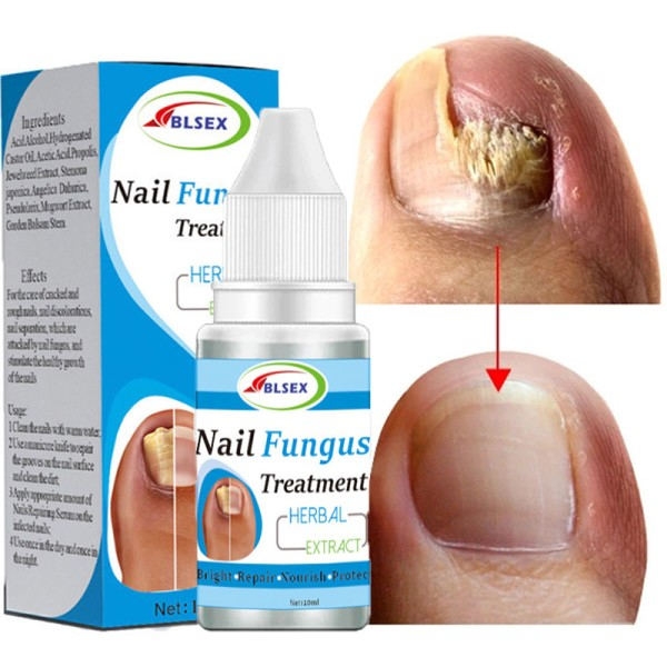 Sopp Negler Behandling for Fingernegler Tånegler Reparasjon Onychomycosis Paronychia Anti Infeksjon