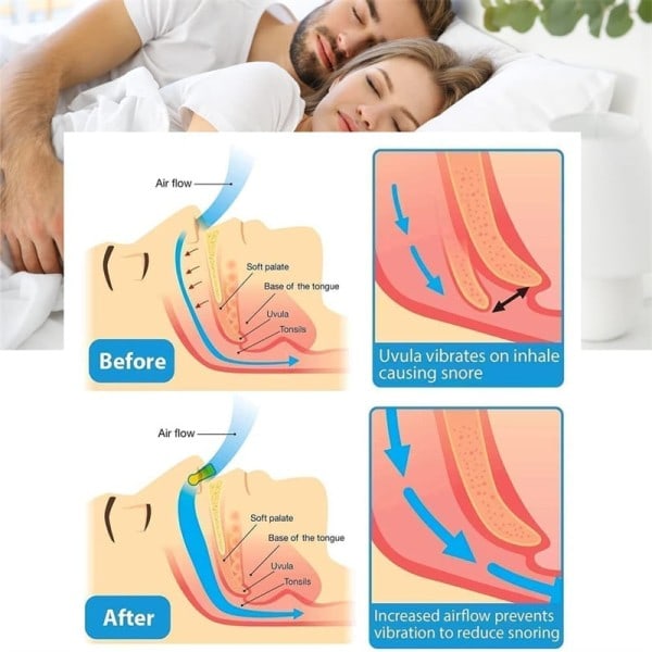 Anti-Snarkning Korrektor Snark Förebyggande Gadget Kvinnor's Anti-Snore Enhet 2 st