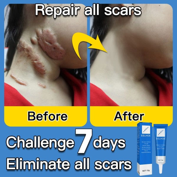 Ar fjernelse creme gel fjern acne pletter behandling stræk mærker forbrænding kirurgi ar reparation creme