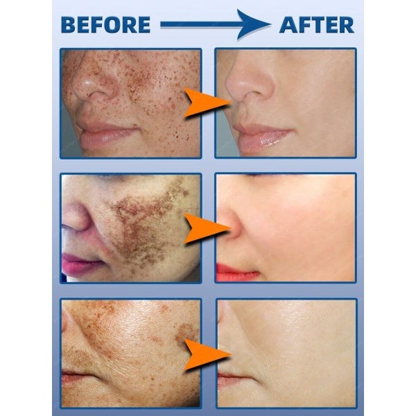 Mørk plet fjerner til ansigt creme  sort alder sol pletter fregne melasma