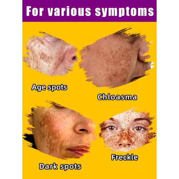 Mørk Plet Fjerner Melasma Chloasma Fregner Plet Fjernelse Creme