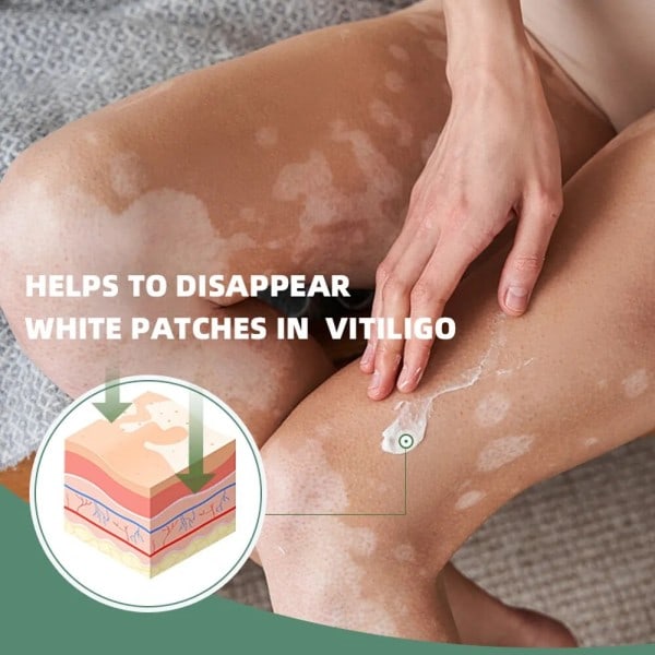 Effektivt vitiligo reparation salve urte fjernelse ringorm hvid plet creme fjern få kvit af hud