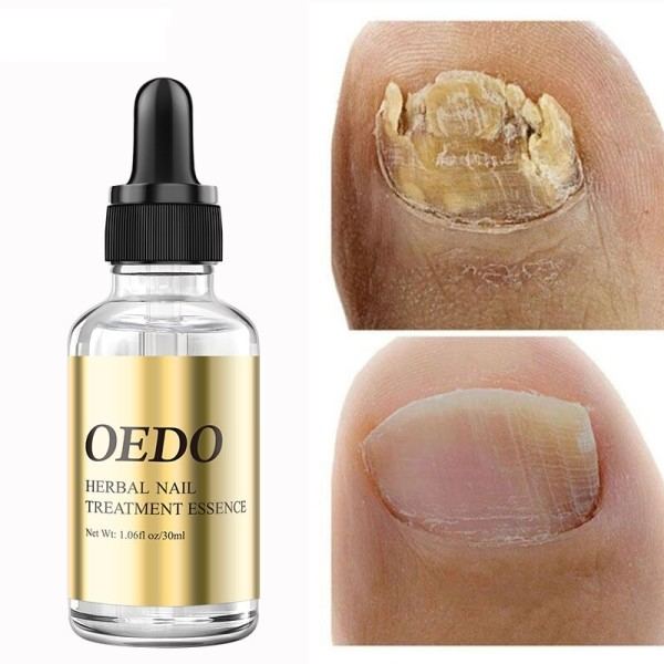 30ml sieni korjaus neste kynsien hoito eteerinen öljy  käsi ja jalkojen valkaisu varpaankynsi sienen poisto
