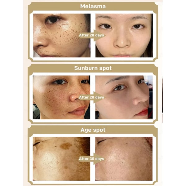 Mörk Fläck Remover for Face Remove Black Chloasma