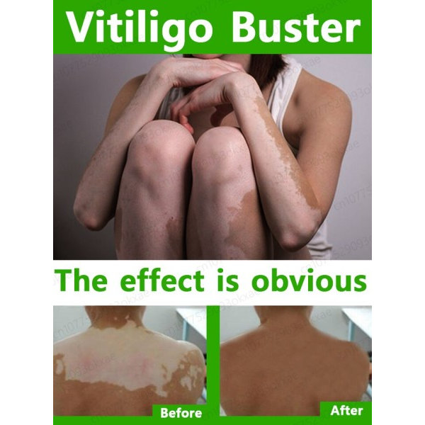 Urte ekstrakt vitiligo salve fjern ringorm hvid pletter fjernelse