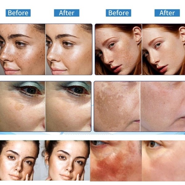 Ansigtsbehandling pletter hud mørk plet fjern melasma alder pletter solpletter hvidning og fregne fjernelse creme
