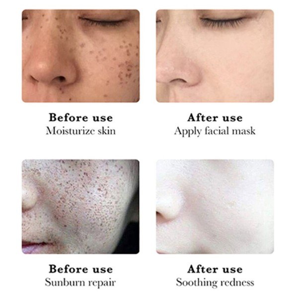 Fräknar Grädde Ta bort Melasma Mörk Fläck Anti-fräknar Essential Essence