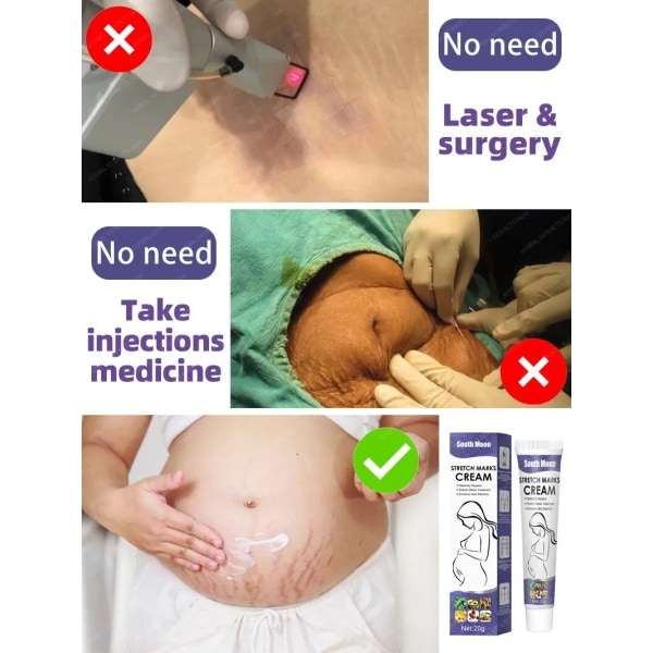 Stretch Marks Permanent Removal Cream Eliminate Body Belly Stretch Marks För tunnlar