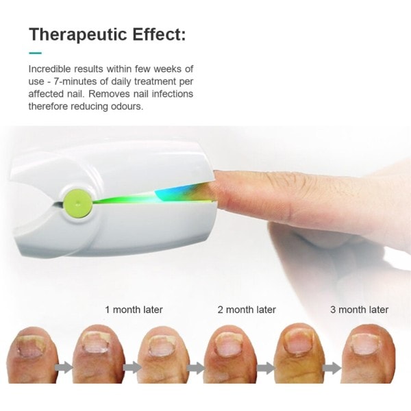 Nagel svamp laser nagelbehandlingar apparat mycket effektiv ljusbehandling för fingernaglar