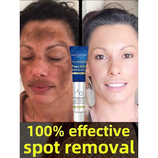 Mørk plet fjerner til ansigt creme  sort alder sol pletter fregne melasma