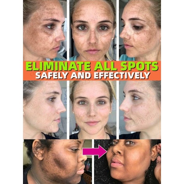 Mörk fläck borttagare för ansikte ta bort melasma borttagning depigmentering