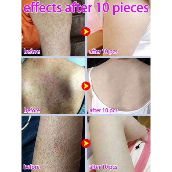 Pilaris Behandling Jordbær Bein Fjerning Bumpy Rough Kylling Skin Fjerner Cream