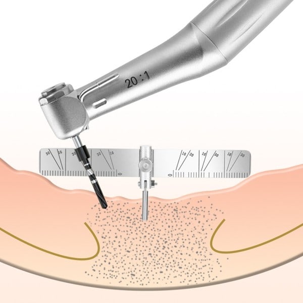 Tann implantat lokalisering guide kirurgisk planting posisjonering lokalisering vinkel linjal måler autoklaverbar