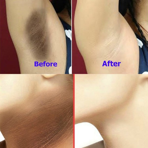 Whitening Tvål Hud Lightening Tvålar Lightening Skin Lighten Mörka Fläckar Handgjord Tvål 5 bitar