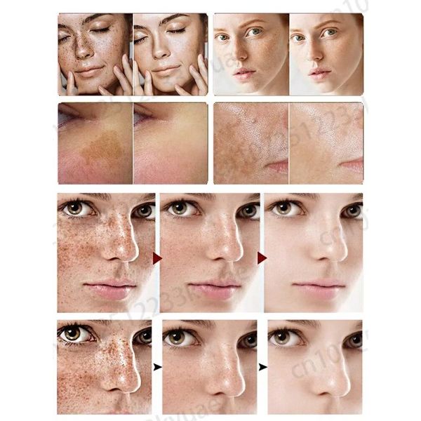 Fregner creme fjerner fregner chloasma mørke pletter pigmentering alder pletter og pletter