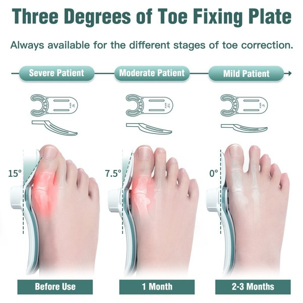 Kniv Korrektor Hallux Valgus Ortotics Big Toe Homing Rightener Justerable Nobs Med 3 Angle