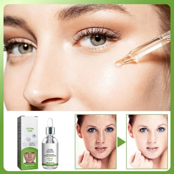 Fregner fjernelse essens fjern ansigtsbehandling pletter hud mørk plet fjern melasma pletter solpletter hvidning og fregne fjernelse creme