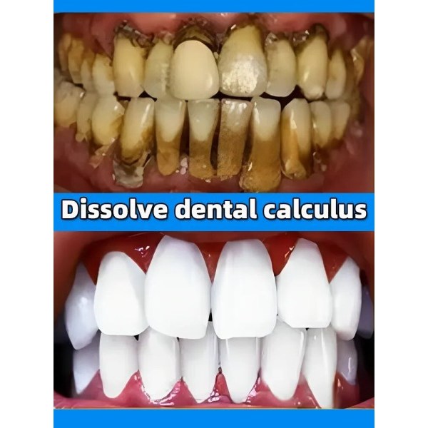 tand tandsten fjerner blegning tænder mund lugt fjernelse dårlig ånde Forebyggelse Periodontitis
