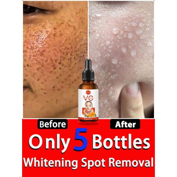 Mörk Fläck Remover for Face Remove Black Chloasma