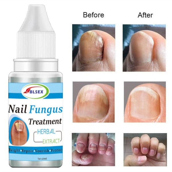 Sopp Negler Behandling for Fingernegler Tånegler Reparasjon Onychomycosis Paronychia Anti Infeksjon