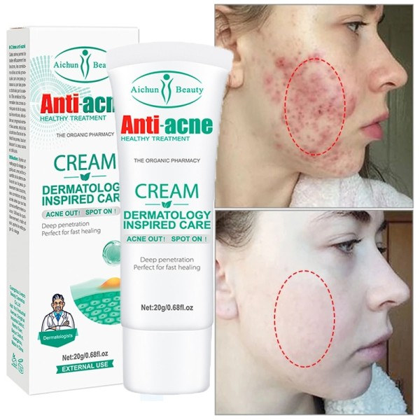 Acne Behandling Creme Pore Shrink Olie Kontrol Hviding Reparation Bums Dyb rengøring Anti-acne Fugtighedscreme
