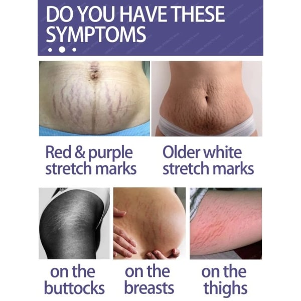 Stretch Marks Permanent Removal Cream Eliminate Body Belly Stretch Marks För tunnlar