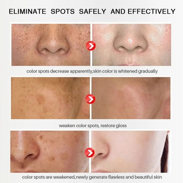 Blegning ansigt creme fjernelse rynker fregne fjernelse anti-acne behandling fade fine linjer
