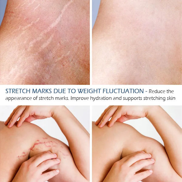 Stretch Marks poistoaine Eteerinen öljy Ihon hoito hoito voide venytys merkkien poistoaine