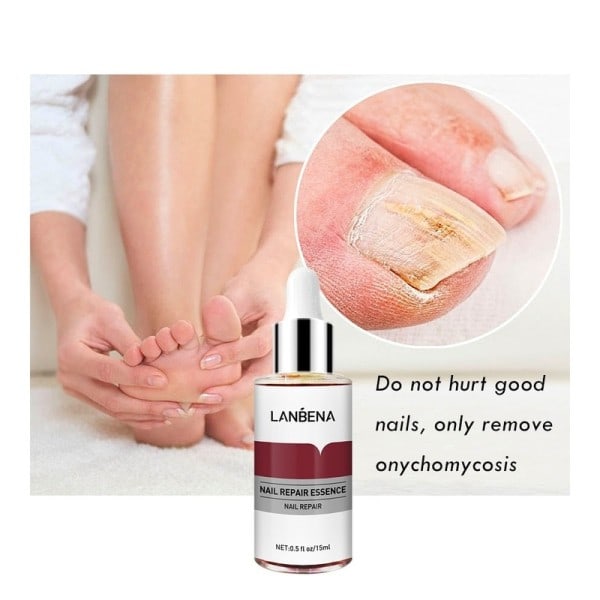 Svamp Nagel Reparation Essence Serum Care Finger Tå Anti Nagel Reparation Fotvård Svamp Nagel Behandling Vätske