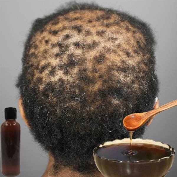 Traction Alopecia hoito hiusten kasvu tuote