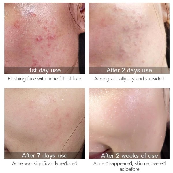 Acne Behandling Serum Återfuktande Närande Torrt Ansiktsvård Firming Shrink Porer Oil Control Multi-effect Skin Essence