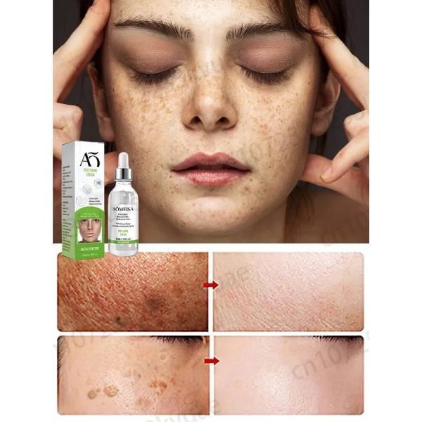 Fregner creme fjerner fregner chloasma mørke pletter pigmentering alder pletter og pletter