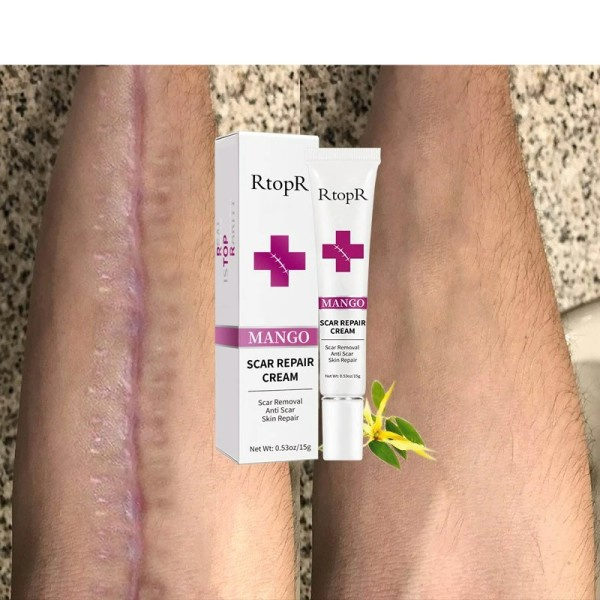 Fade Är Stretch Marks Remover Cream Skin Repair Ansikte Cream Acne Fläckar Acne Behandling
