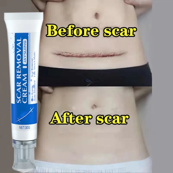 Urte ar fjernelse creme stretch mærker gel reparation pock mærke forbrænding kirurgisk ar fjerner