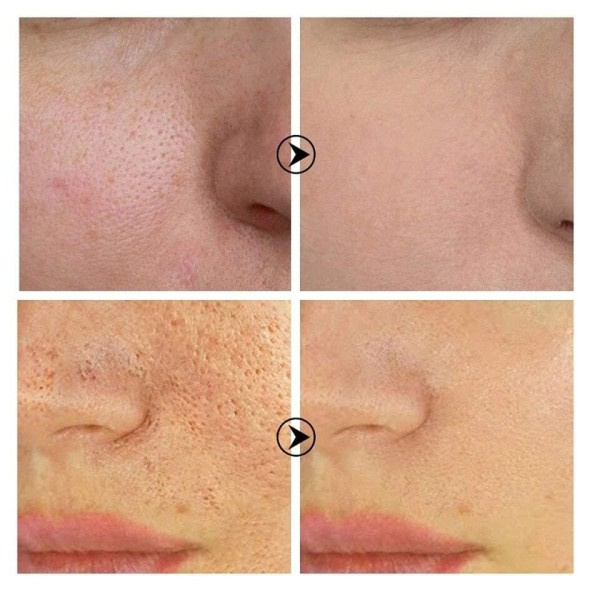 Hud Textur Por Refining Resurfacing Lightening Ansikts Serum med Retinol och Niacinamid