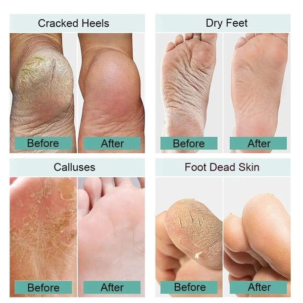 Elektrisk Fod Fil Callus Fjerner Kalk Til Fødder Og Hæle Elektrisk Fod Sandpapir Pedicure Fod Eksfoliator