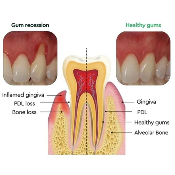 30ml Dentizen Gum Återväxt Droppar Lättande Munn Periodontal Gum Smärta Behandling
