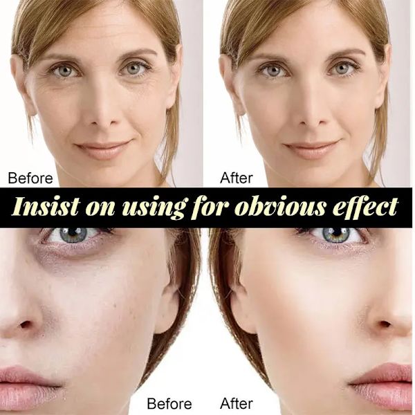 Instant Lift Collagen Protein Thread Set Face Filler Absorbable Thread Firming Silke Fibroin Line Carving Anti-aging Face Essence
