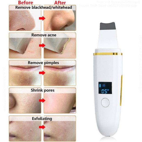 Ultralyd Skin Scrubber Fjerner Sorthoved Ultrasonic Peeling Facial Scrubber