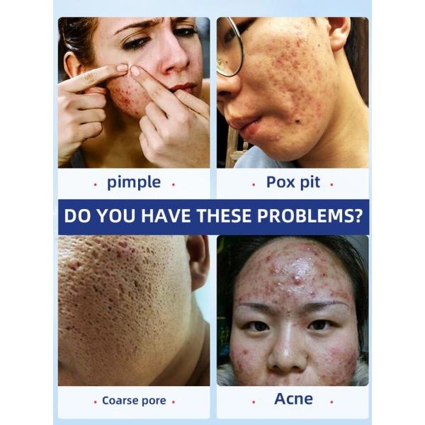 acne fjerner creme Til anti ansigtsmærker fjernelse hudorme og bumser serum