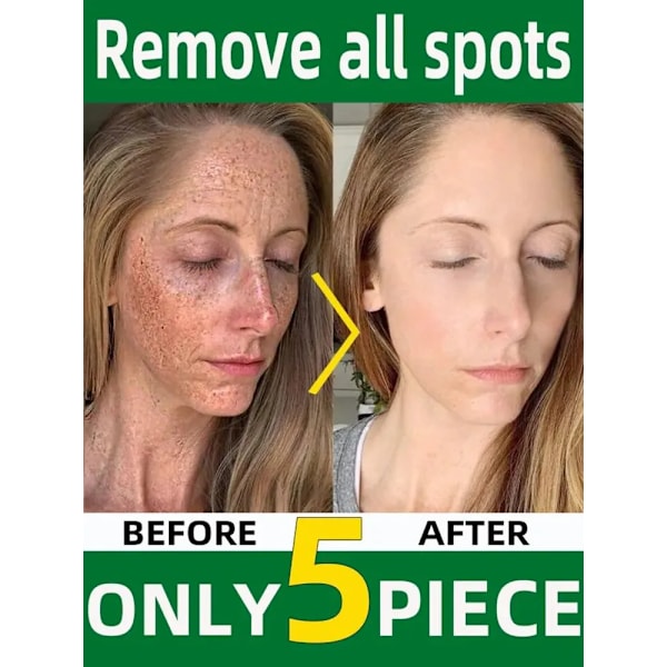 Mørke flekker fjerner for ansikt sol melasma fregner pigment alder flekker fjerning
